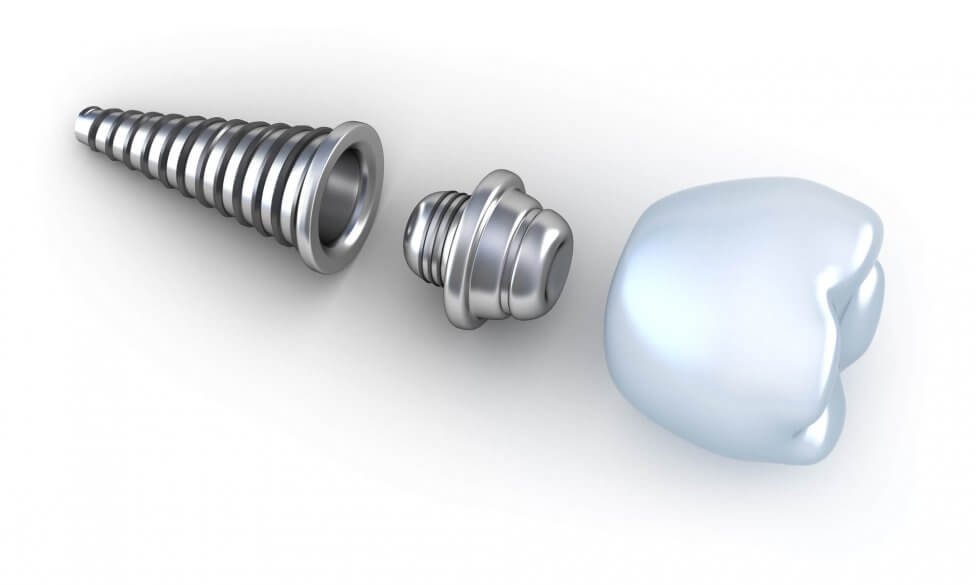 Dental Implants North Miami