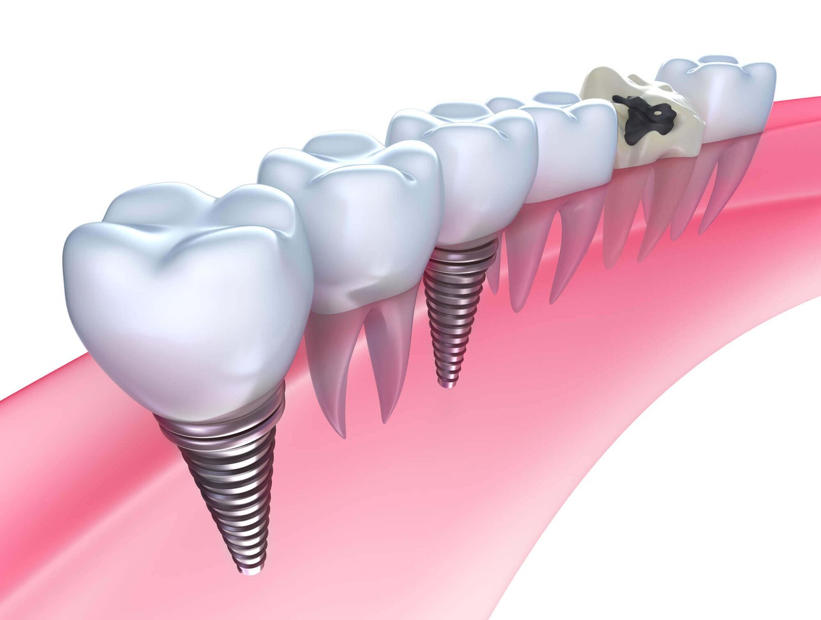 Dental Implants North Miami