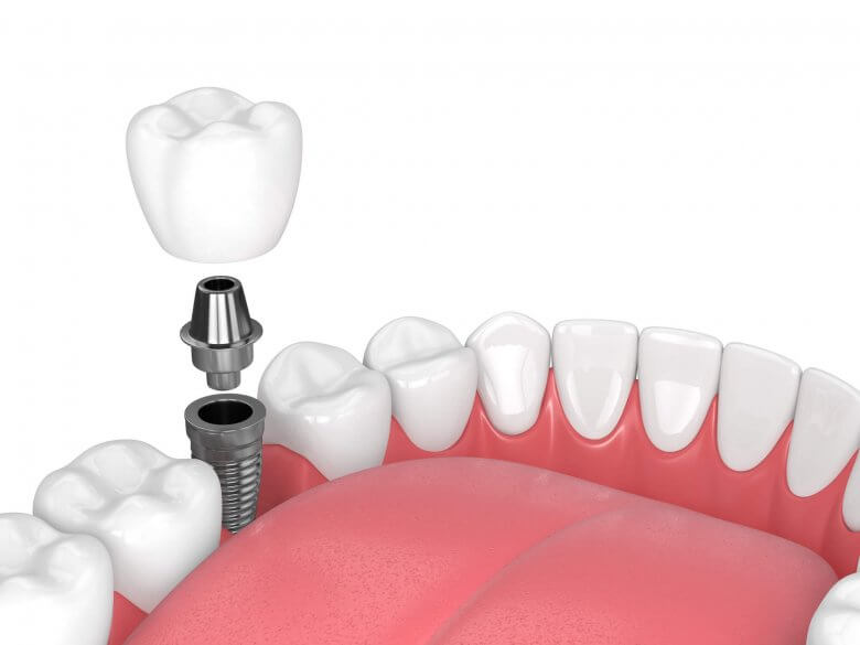 3d render of jaw with teeth and Dental Implants North Miami