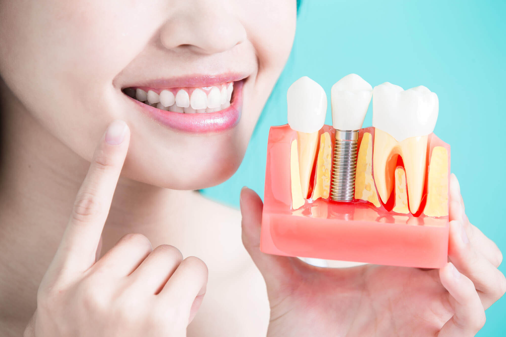 Woman holding tooth dental implants in Aventura