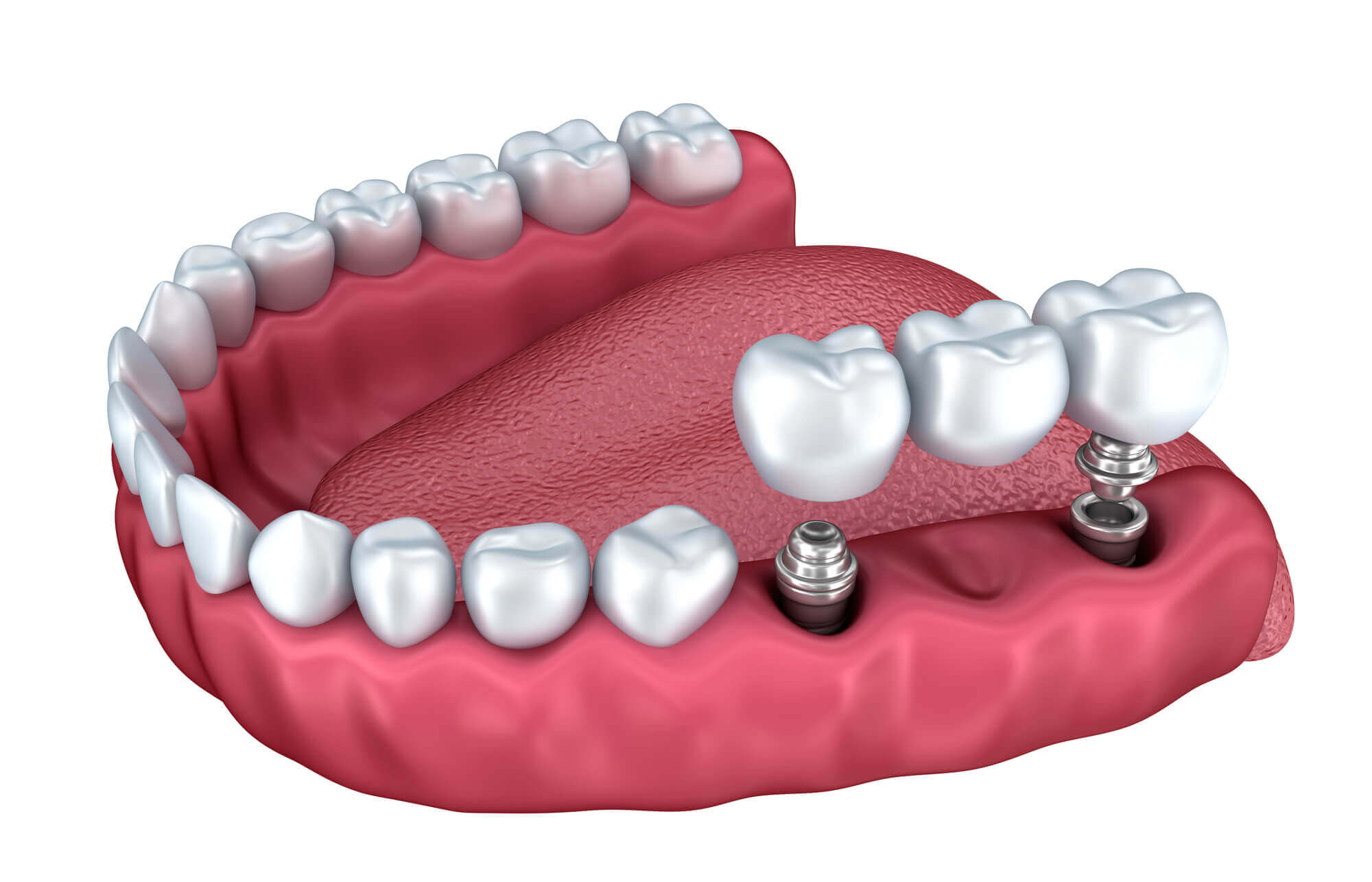 illustration of dental implants in Aventura