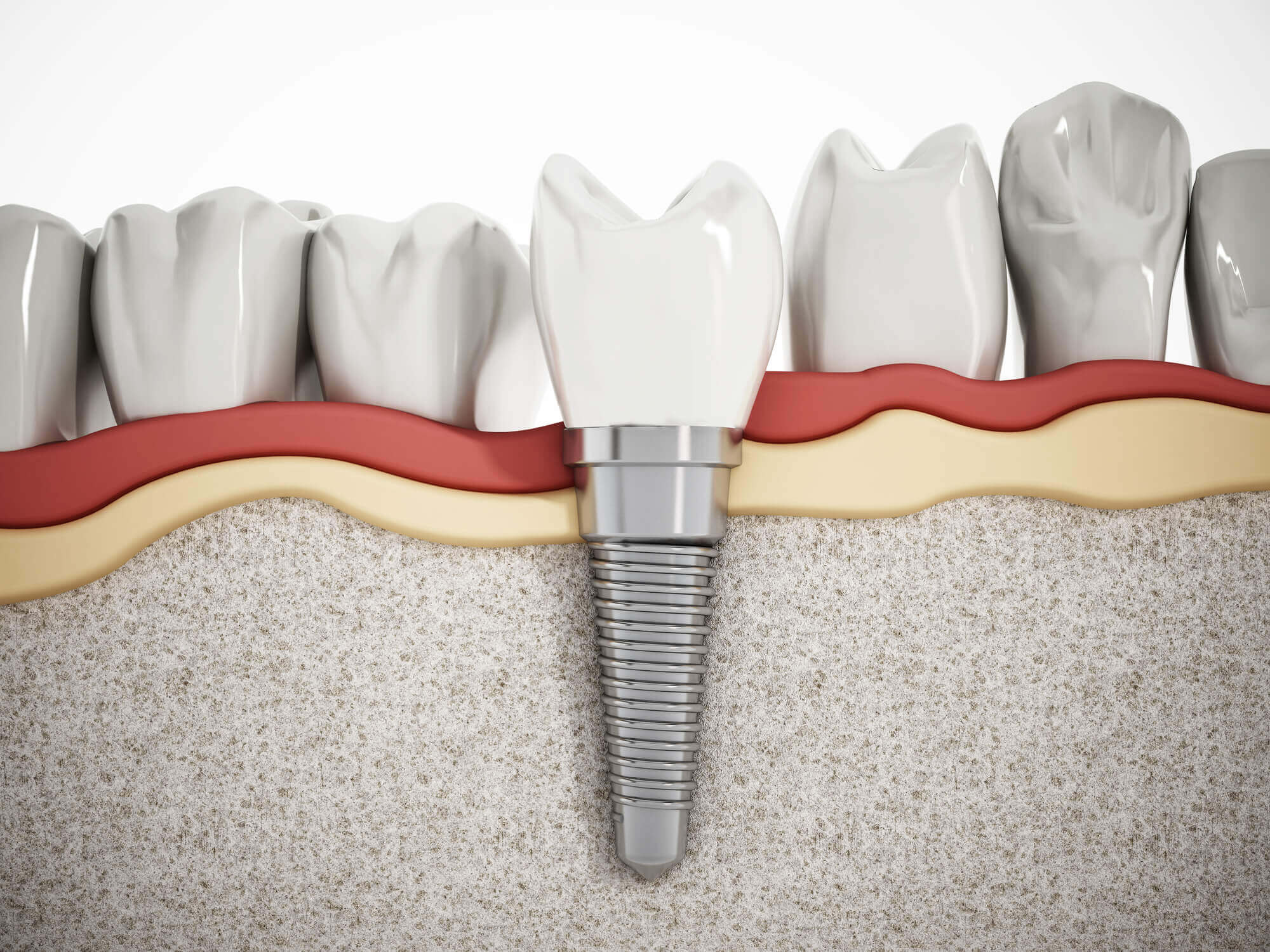illustration of Dental Implants in North Miami 
