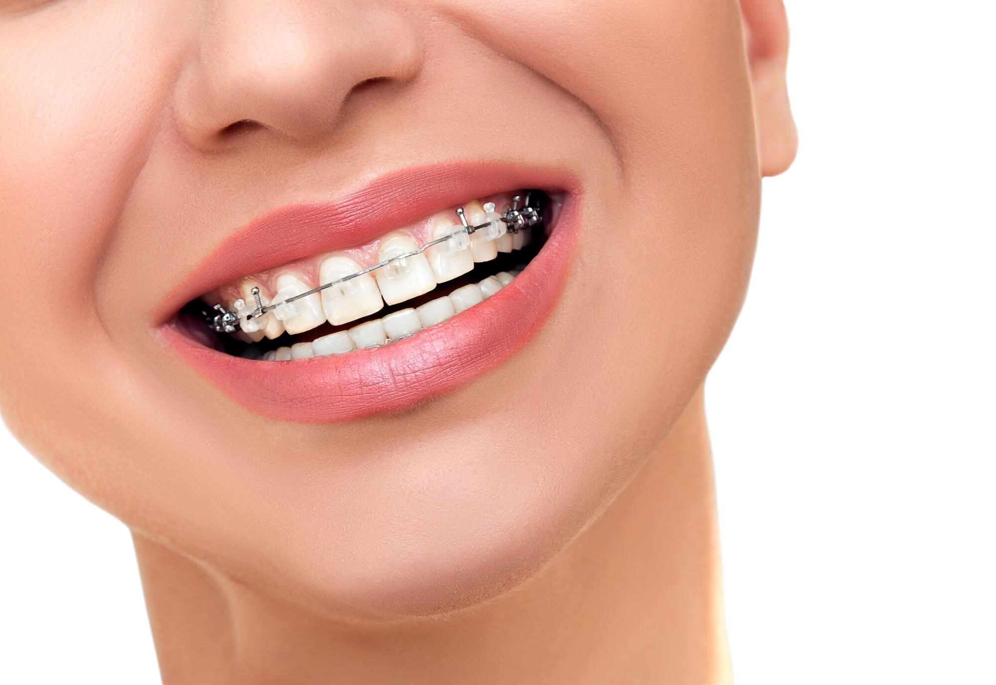 woman's smile with Orthodontics in Aventura