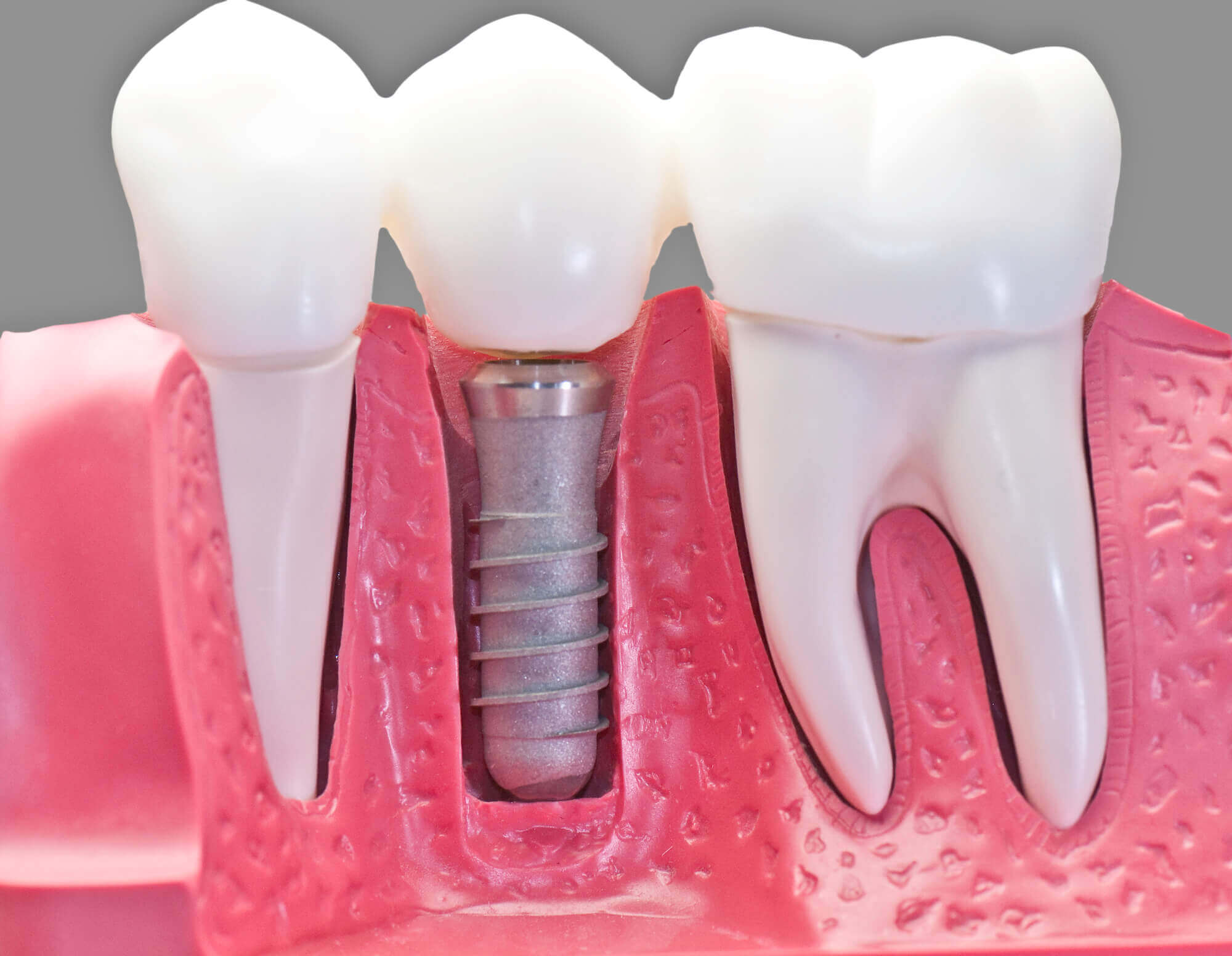 Dental Implants North Miami model
