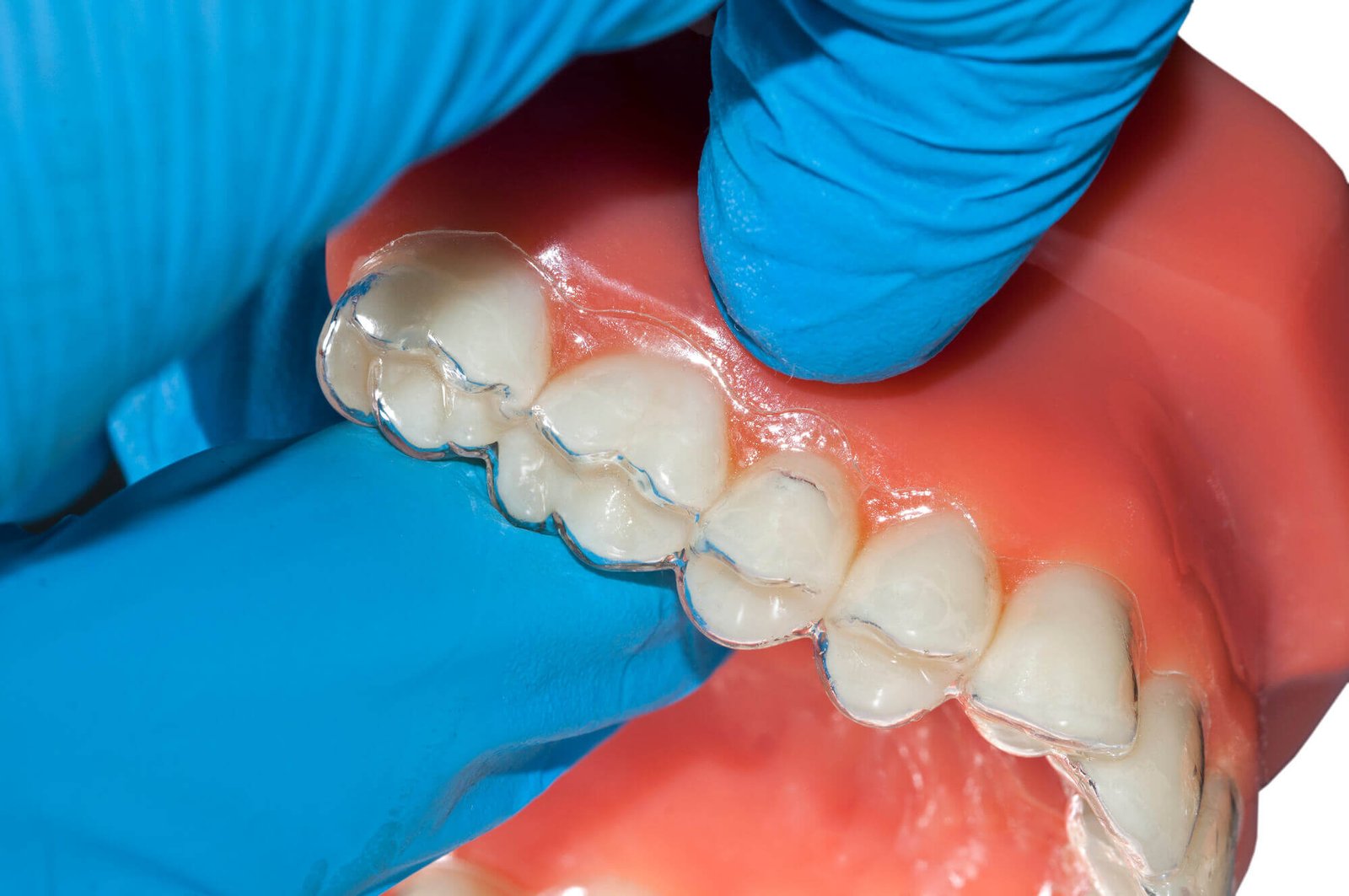 Invisalign North Miami in teeth model