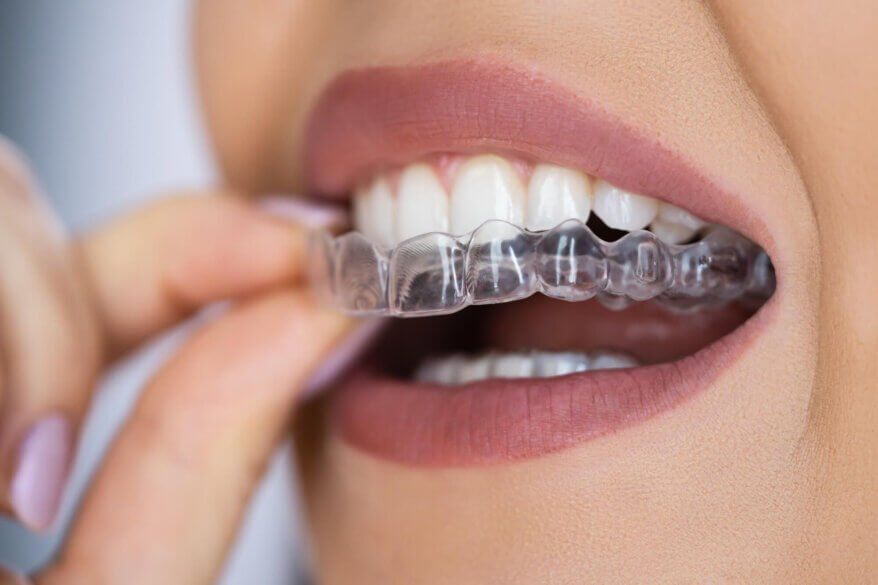 woman wearing Invisalign North Miami