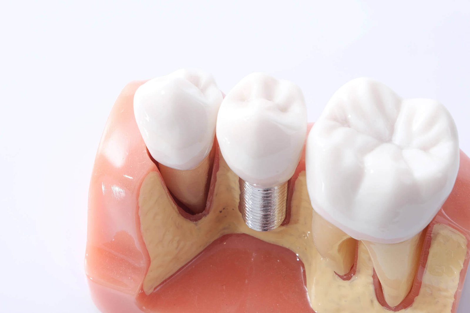 Dental Implants North Miami model