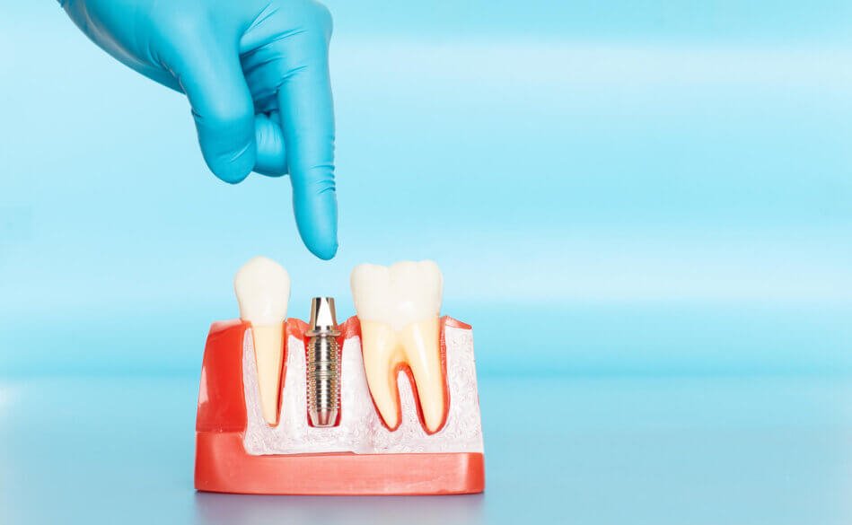 Dental Implants in Sunny Isles FL