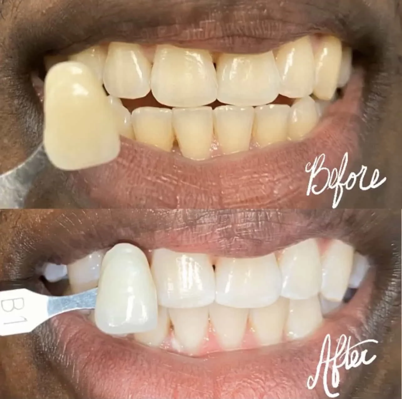 Porcelain Veneers