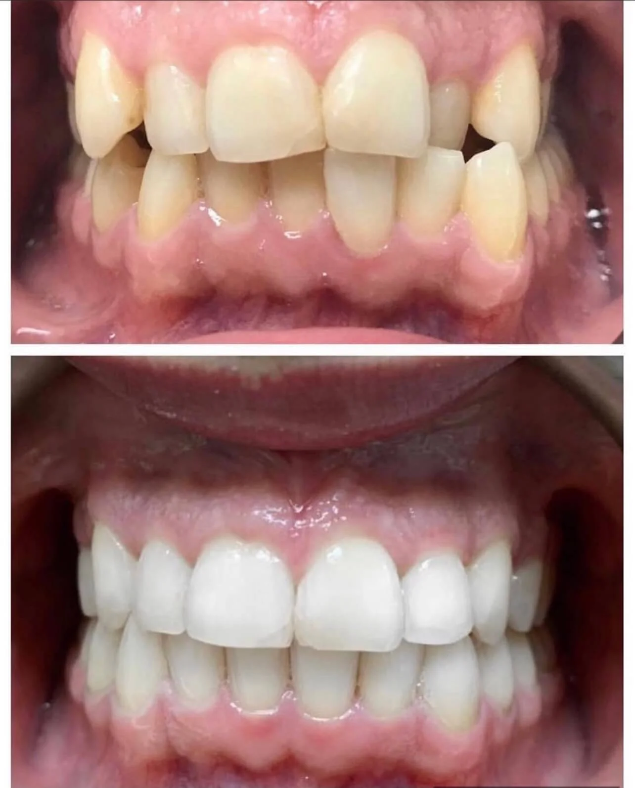 Invisalign Case