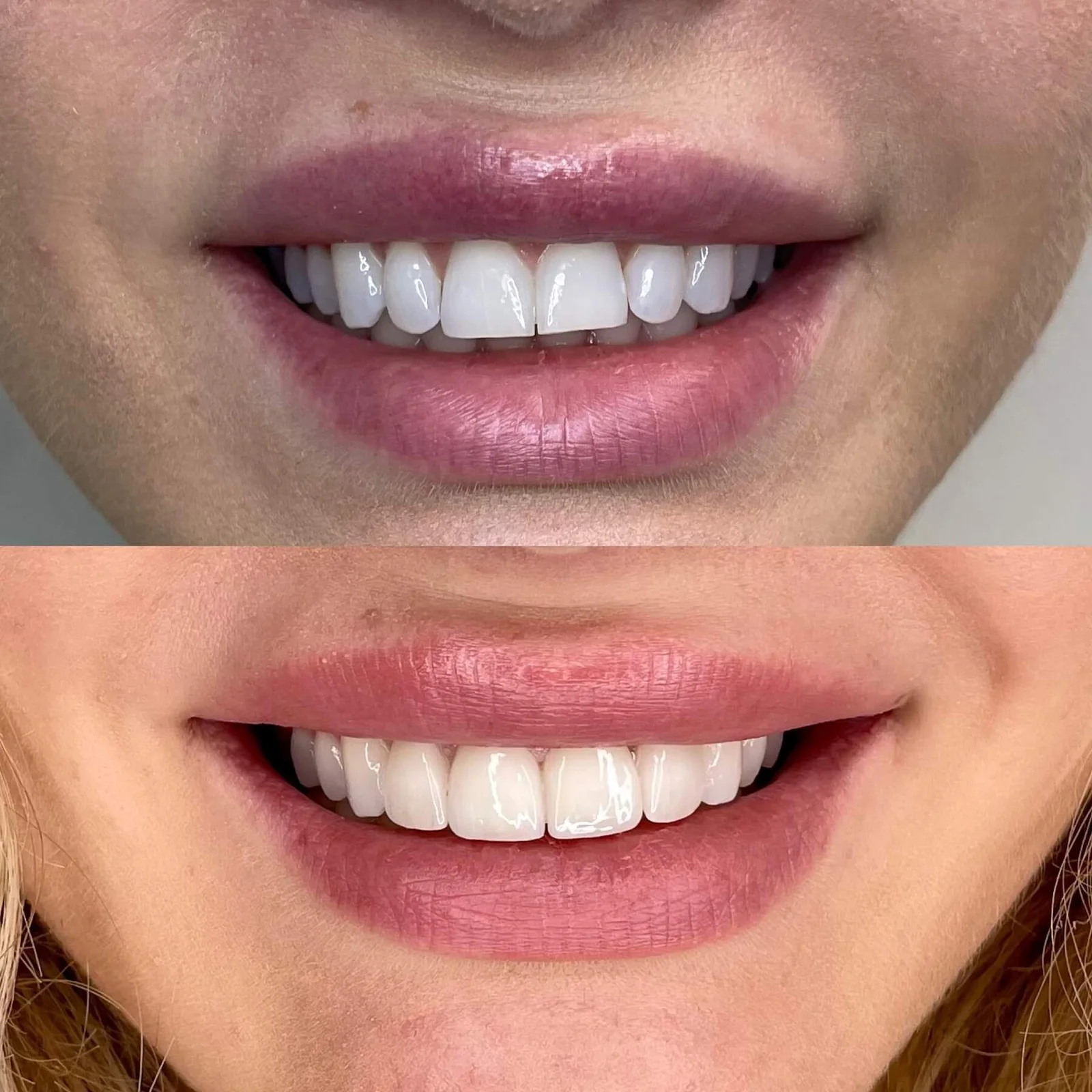 Porcelain Veneers