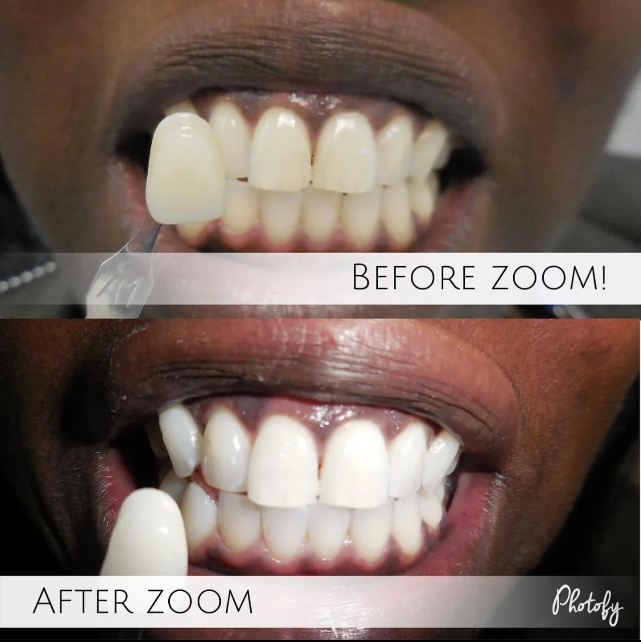 Zoom Whitening